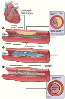 220px-PTCA_stent_NIH.gif